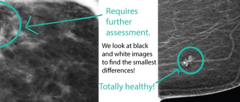 Effective Ways to Get Rid of Breast Calcifications Naturally in 2025: Discover Proven Techniques