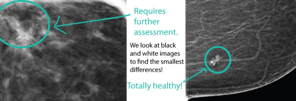 Effective Ways to Get Rid of Breast Calcifications Naturally in 2025: Discover Proven Techniques