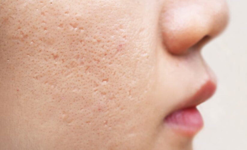 Smart Ways to Get Rid of Tiny Bumps on Face Quickly in 2025 – Discover Effective Solutions!